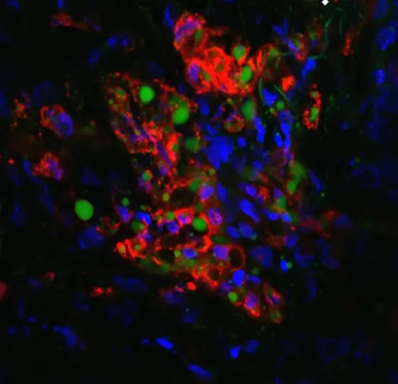 A fluorescent microscopy image of a tissue section from a peritoneal metastasis, showing lipid droplets in green and lipid-laden macrophages in red, with cell nuclei stained blue against a dark background.